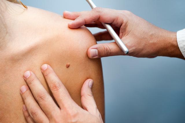 Apel državi: Omoguæite terapiju svim obolelim od melanoma
